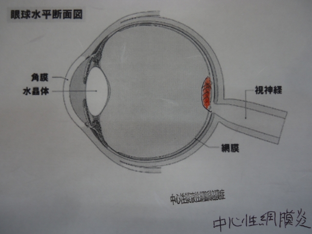 中心性網膜炎